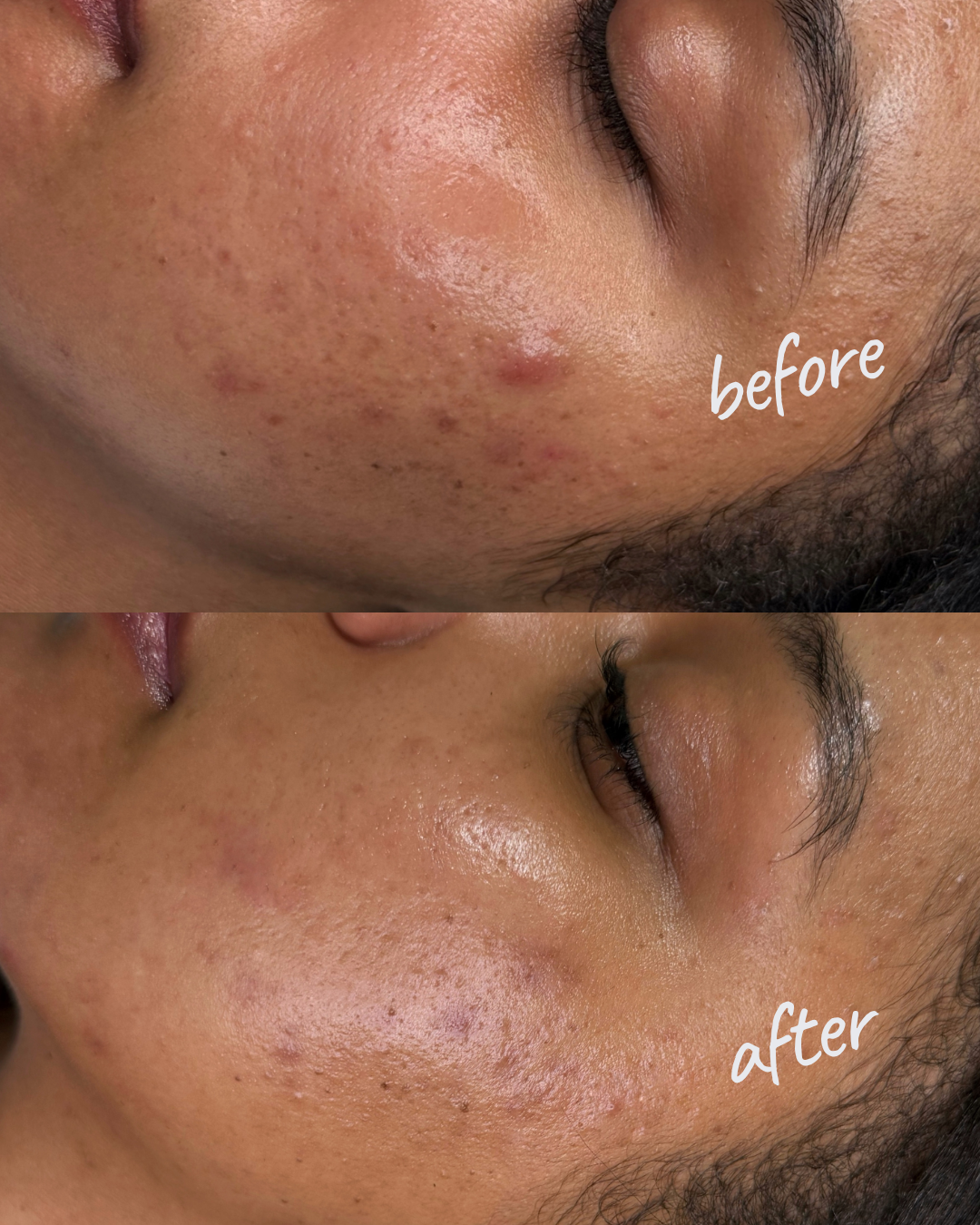 Before and After Dermal Fillers Lips Brooklyn NYC