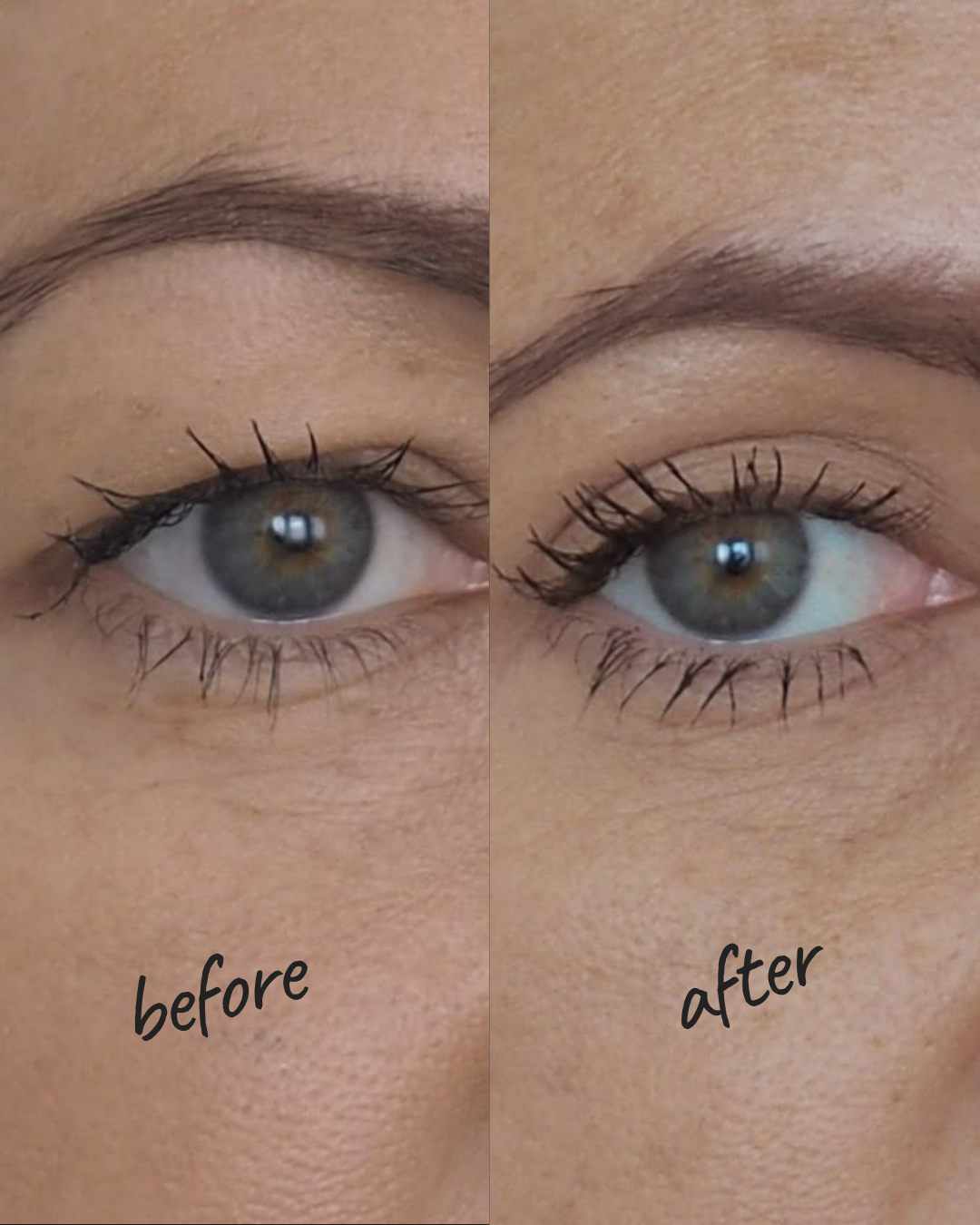 Before and After Dermal Fillers Lips Brooklyn NYC