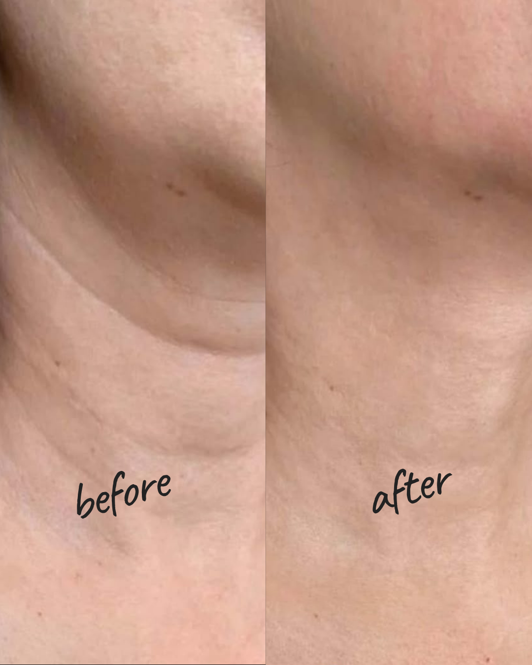 Biorevitalization Result — Hydrated Glowing Skin NYC