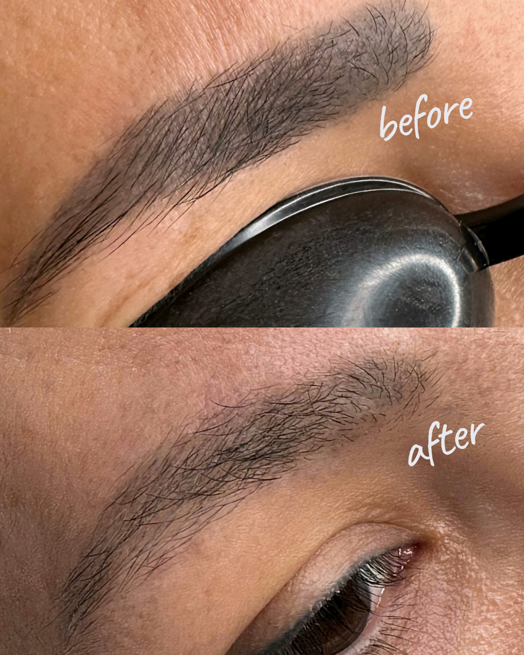 PRP Hair Restoration — Hair Growth Result NYC